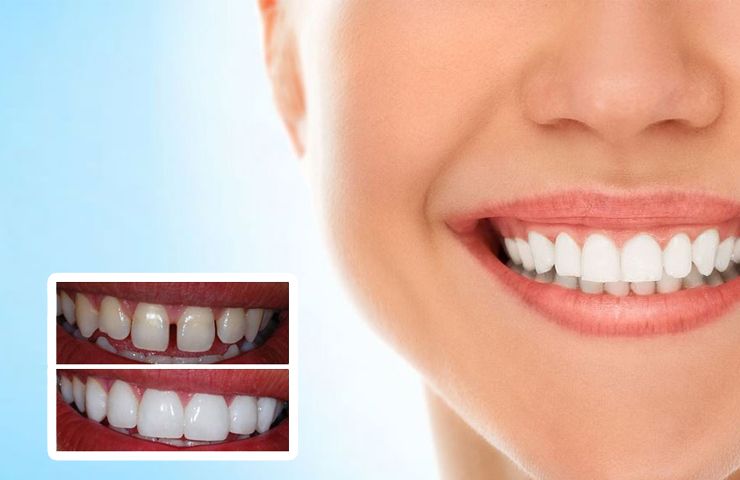 Estética Dental - Lentes de contato dental a queridinha dos sorrisos perfeitos.