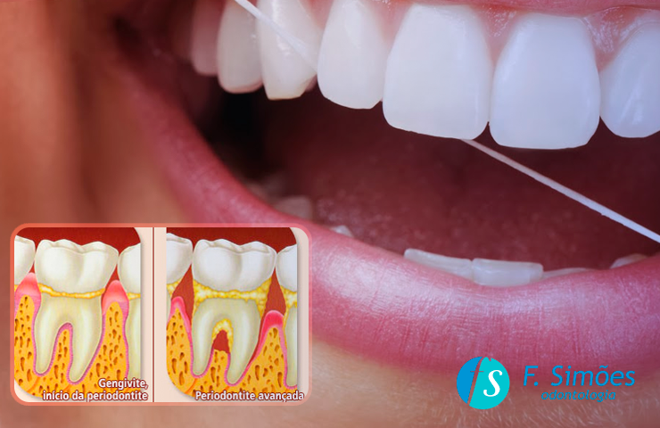 Tratamentos odontológico para doenças periodontais