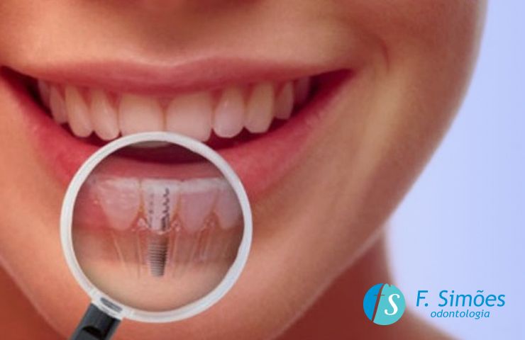 Implante Dentário - como funcionam