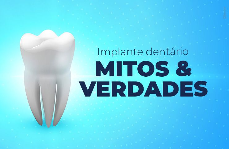 Implante dentário: chegou a hora de desvendar os mitos e verdades deste procedimento!